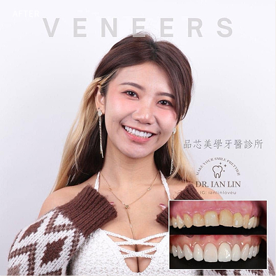 陶瓷美學貼片案例,治療前後對比