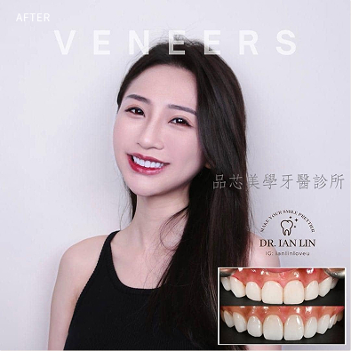 陶瓷美學貼片案例,治療前後對比