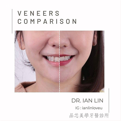 陶瓷美學貼片案例,治療前後對比