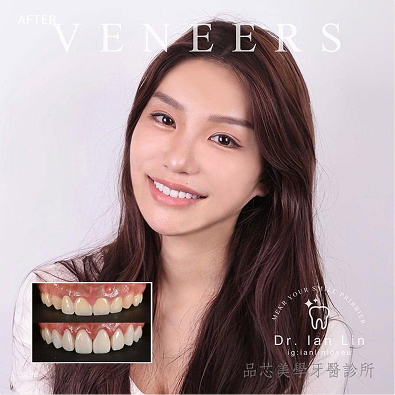 陶瓷美學貼片案例,治療前後對比