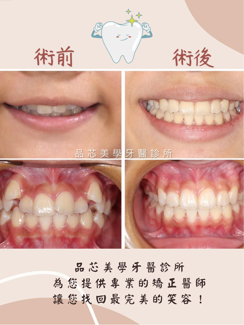 齒顎矯正案例,治療前後齒列對比